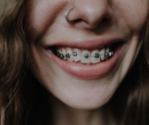 fiksni aparatić, fiksni ortodonski aparatić, fiksna otrodonska naprava